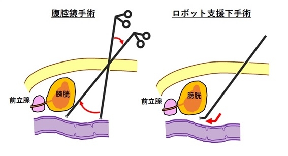 20230531　2外下部消化管　ｍｖ1ダビンチ　下部消化管鳥居先生　画像.jpg