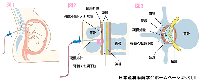 硬膜外麻酔概要図