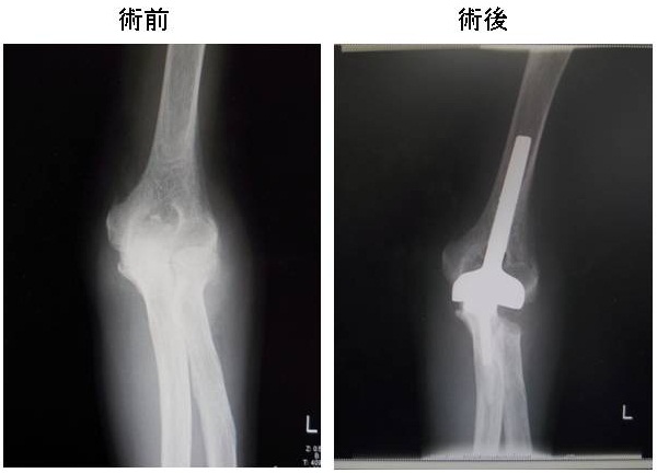 人工肘関節置換術