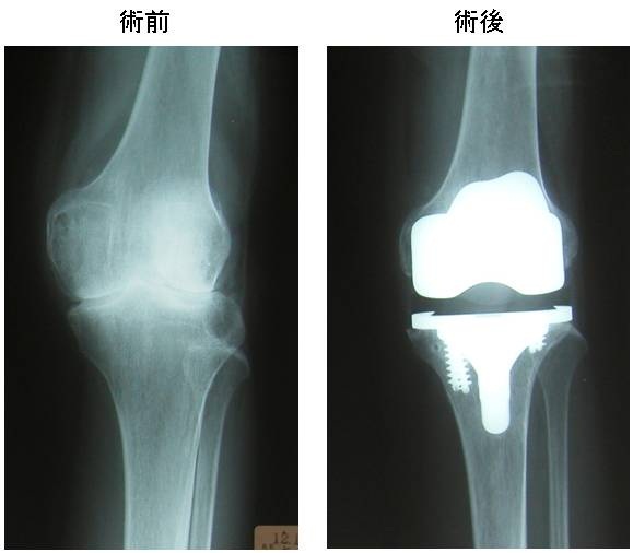 人工膝関節置換術