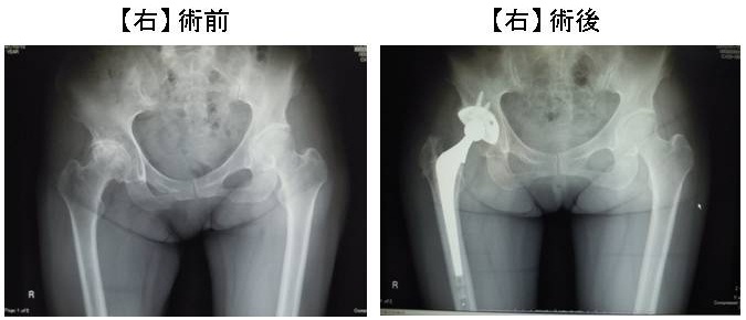 人工股関節置換術