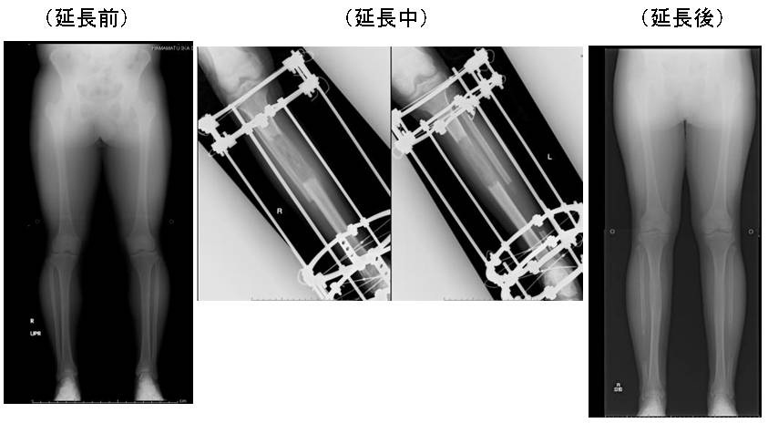 骨延長