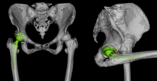 図2 人工股関節の脱臼シミュレーション