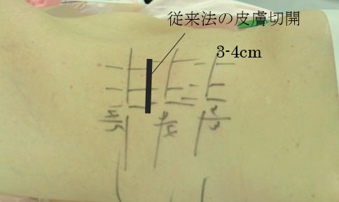 従来法の皮膚切開 3～4センチ