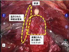 ロボット支援前立腺全摘除術（術部の様子）