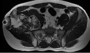 骨軟部腫瘍領域　写真1